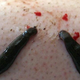 Illustration for article titled Best Leech Therapy Treatment In India